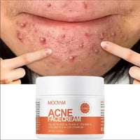 Before and after using Kazven Clear Skin anti-acne cream