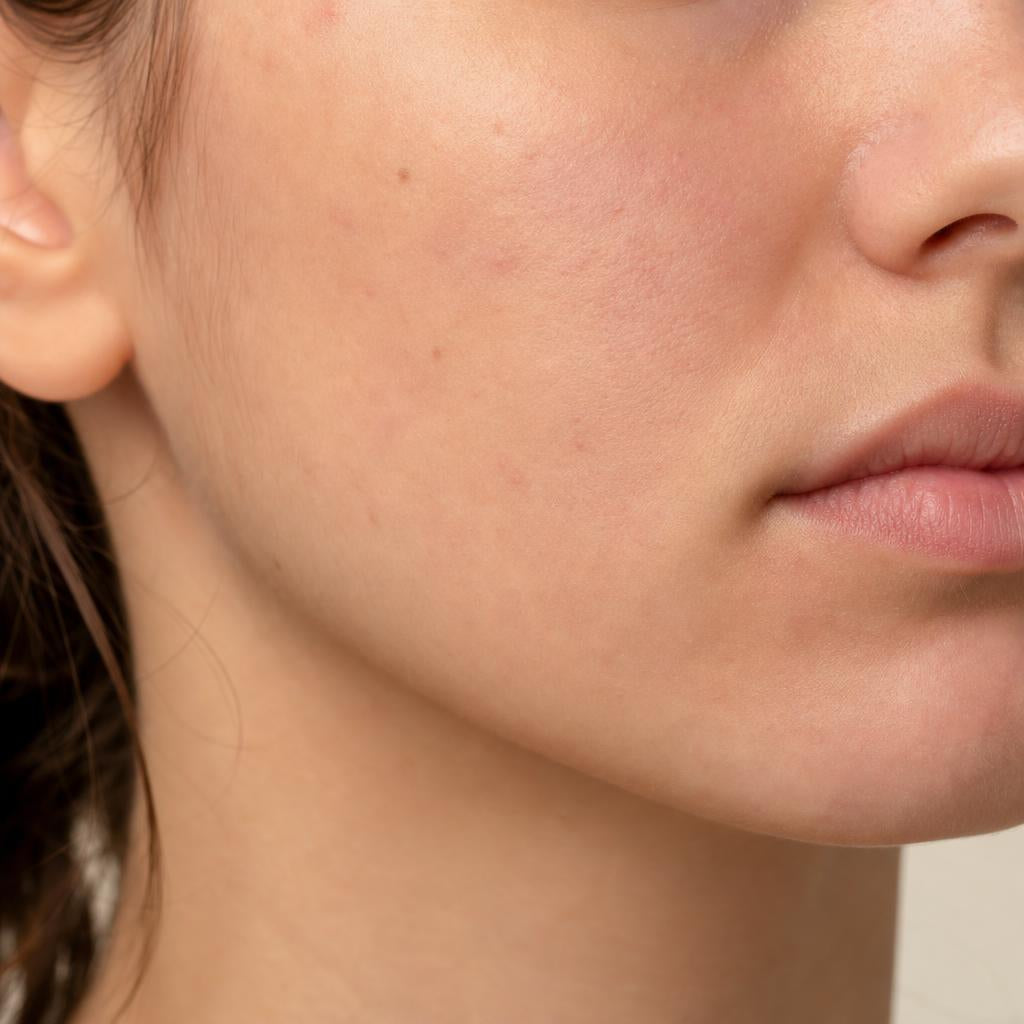 Skin with acne before using Kazven Clear Skin cream